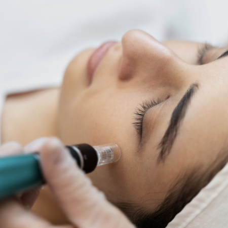 Microneedling in Cape Girardeau